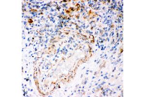 Anti- IP3 receptor antibody,IHC(P) IHC(P): Human Lung Cancer Tissue