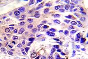 Immunohistochemistry (IHC) analyzes of p-GSK3alpha antibody in paraffin-embedded human breast carcinoma tissue. (GSK3 alpha 抗体  (pSer21))