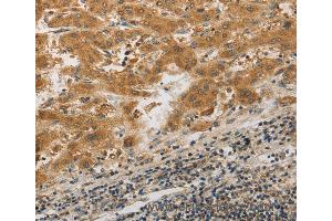 Immunohistochemistry of Human liver cancer using PIBF1 Polyclonal Antibody at dilution of 1:20 (PIBF1 抗体)