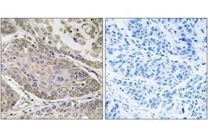 Immunohistochemistry analysis of paraffin-embedded human lung carcinoma, using PLA2G4E Antibody. (PLA2G4E 抗体  (AA 401-450))