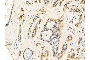 beta Catenin Mouse Monoclonal Antibody at 1/100 staining human breast cancer by IHC-P.
