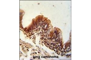 TXNDC6 antibody (Center) (ABIN654968 and ABIN2844606) immunohistochemistry analysis in formalin fixed and paraffin embedded human lung carcinoma followed by peroxidase conjugation of the secondary antibody and DAB staining. (NME9 抗体  (AA 111-139))