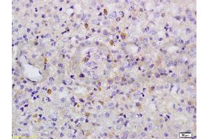 Formalin-fixed and paraffin embedded human liver carcinoma labeled with Anti-Phospho-Wee1(Ser642) Polyclonal Antibody, Unconjugated (ABIN746873) at 1:200 followed by conjugation to the secondary antibody and DAB (WEE1 抗体  (pSer642))