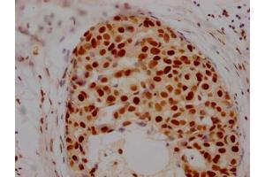 IHC image of ABIN7127538 diluted at 1:100 and staining in paraffin-embedded human breast cancer performed on a Leica BondTM system. (Recombinant HDAC2 抗体)
