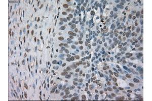 Immunohistochemical staining of paraffin-embedded Adenocarcinoma of colon tissue using anti-BUB1Bmouse monoclonal antibody. (BUB1B 抗体)