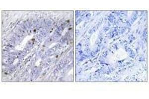 Immunohistochemistry analysis of paraffin-embedded human colon carcinoma tissue using Nuclear Receptor NR4A1 (Ab-351) antibody.