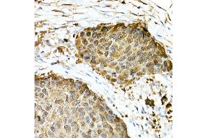 Immunohistochemistry of paraffin-embedded Human esophageal cancer using GST3/GSTP1 antibody (ABIN7267448) at dilution of 1:100 (40x lens). (GSTP1 抗体)