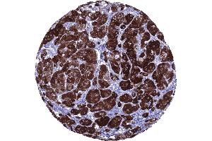 Strong inhibin alpha immunostaining in all cells of an adrenocortical adenoma (Recombinant Inhibin alpha 抗体  (AA 233-362))