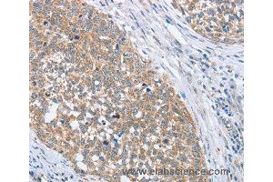 Immunohistochemistry of Human gastric cancer using PAPSS1 Polyclonal Antibody at dilution of 1:40 (PAPSS1 抗体)