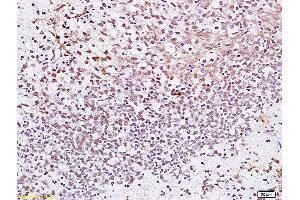 Formalin-fixed and paraffin embedded human gastric carcinoma labeled with Anti CENPF Polyclonal Antibody, Unconjugated (ABIN872667) at 1:200 followed by conjugation to the secondary antibody and DAB staining. (CENPF 抗体  (AA 551-650))