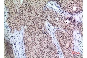 Immunohistochemistry (IHC) analysis of paraffin-embedded Human Mammary Cancer, antibody was diluted at 1:100. (P57 (Ser24) 抗体)