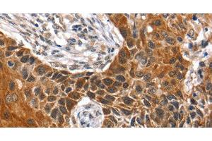 Immunohistochemistry of paraffin-embedded Human esophagus cancer tissue using HOXB1 Polyclonal Antibody at dilution 1:40 (HOXB1 抗体)