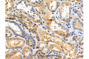 ABIN6258004 and ABIN6275034 at 1/100 staining Human kidney cancer and adjacent normal tissues by IHC-P. (CD55 抗体  (Internal Region))