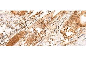 Immunohistochemistry of paraffin-embedded Human esophagus cancer tissue using SCAND1 Polyclonal Antibody at dilution of 1:90(x200) (SCAND1 抗体)