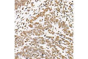 Immunohistochemistry of paraffin-embedded human colon carcinoma using Phospho-ST-Y705 Rabbit mAb (ABIN6135325, ABIN6136266, ABIN6136267 and ABIN7101883) at dilution of 1:100 (40x lens). (STAT3 抗体  (pTyr705))