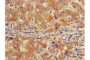 Immunohistochemistry of paraffin-embedded human liver cancer using ABIN7153517 at dilution of 1:100 (GABARAPL1 抗体  (AA 1-117))