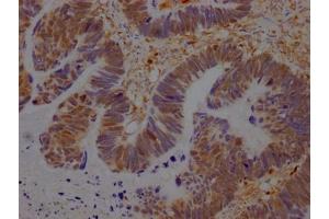 IHC image of ABIN7127524 diluted at 1:100 and staining in paraffin-embedded human ovarian cancer performed on a Leica BondTM system. (Recombinant GRB2 抗体)