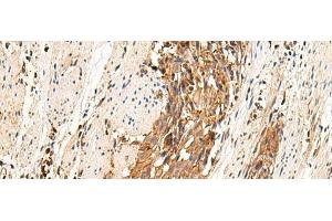 Immunohistochemistry of paraffin-embedded Human esophagus cancer tissue using MRGPRD Polyclonal Antibody at dilution of 1:25(x200)