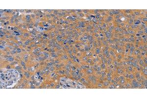 Immunohistochemistry of paraffin-embedded Human cervical cancer tissue using BOD1 Polyclonal Antibody at dilution 1:60 (BOD1 抗体)