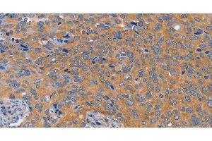 Immunohistochemistry of paraffin-embedded Human cervical cancer tissue using BOD1 Polyclonal Antibody at dilution 1:60