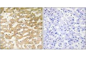 Immunohistochemistry analysis of paraffin-embedded human liver carcinoma tissue, using FADD Antibody. (FADD 抗体  (AA 101-150))