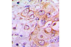 Immunohistochemical analysis of PFKFB2 staining in human lung cancer formalin fixed paraffin embedded tissue section. (PFKFB2 抗体  (N-Term))