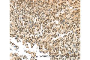 Immunohistochemistry of Human thyroid cancer using APOL6 Polyclonal Antibody at dilution of 1:60 (APOL6 抗体)
