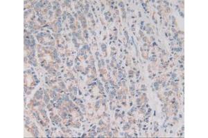 IHC-P analysis of Human Prostate Gland Cancer Tissue, with DAB staining.