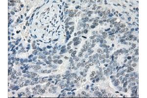 Immunohistochemical staining of paraffin-embedded Adenocarcinoma of colon tissue using anti-LTA4H mouse monoclonal antibody. (LTA4H 抗体)