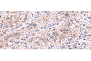 Immunohistochemistry of paraffin-embedded Human liver cancer tissue using G6PC Polyclonal Antibody at dilution of 1:50(x200) (G6PC 抗体)