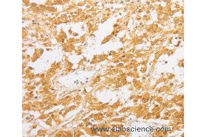 Immunohistochemistry of Human thyroid cancer using PDE4D Polyclonal Antibody at dilution of 1:20