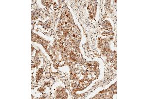 Immunohistochemical analysis of paraffin-embedded Human breast carcinoma tissue using (ABIN6243695 and ABIN6578909) performed on the Leica® BOND RXm. (HSP70 1A 抗体)