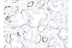 Formalin-fixed, paraffin-embedded human Prostate Carcinoma stained with Cytokeratin, HMW Mouse Monoclonal Antibody (34BE12). (Cytokeratin 2 抗体)