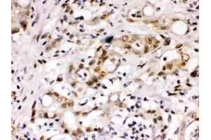 Cyclin T1 was detected in paraffin-embedded sections of human intestinal cancer tissues using rabbit anti- Cyclin T1 Antigen Affinity purified polyclonal antibody (Catalog # ) at 1 µg/mL. (Cyclin T1 抗体  (Middle Region))