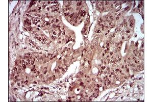 Immunohistochemical analysis of paraffin-embedded rectum cancer tissues using DAPK3 mouse mAb with DAB staining. (DAPK3 抗体  (AA 28-161))