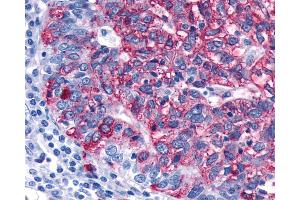 Anti-FZD3 / Frizzled 3 antibody IHC of human Ovary, Carcinoma. (FZD3 抗体)