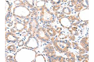 The image on the left is immunohistochemistry of paraffin-embedded Human thyroid cancer tissue using ABIN7128109(AADACL2 Antibody) at dilution 1/25, on the right is treated with fusion protein. (AADACL2 抗体)