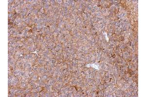 IHC-P Image Immunohistochemical analysis of paraffin-embedded PC13 xenograft, using PHGDH, antibody at 1:500 dilution. (PHGDH 抗体  (N-Term))