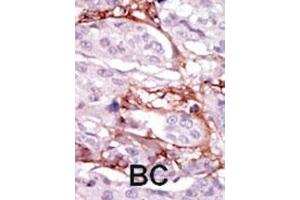 Formalin-fixed and paraffin-embedded human cancer tissue reacted with the primary antibody, which was peroxidase-conjugated to the secondary antibody, followed by DAB staining. (STK31 抗体  (N-Term))