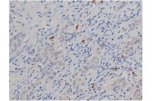 ABIN6267338 at 1/200 staining Human ganstric cancer tissue sections by IHC-P. (HSP90AB1 抗体  (pSer254))