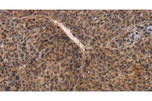 Immunohistochemistry of paraffin-embedded Human liver cancer using CDC34 Polyclonal Antibody at dilution of 1:50 (CDC34 抗体)