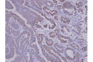 IHC-P Image Immunohistochemical analysis of paraffin-embedded human thyroid cancer, using SNX12, antibody at 1:100 dilution. (SNX12 抗体  (C-Term))