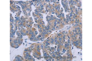Immunohistochemistry of Human prostate cancer using P2RY2 Polyclonal Antibody at dilution of 1:40 (P2RY2 抗体)