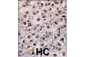 Formalin-fixed and paraffin-embedded human hepatocarcinoma tissue reacted with PEMT antibody (N-term) (ABIN650614 and ABIN2844055) , which was peroxidase-conjugated to the secondary antibody, followed by DAB staining. (PEMT 抗体  (N-Term))