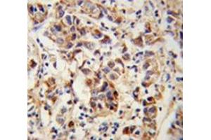Immunohistochemistry analysis of human breast carcinoma (Formalin-fixed, Paraffin-embedded) using SPRR1B / Cornifin-B Antibody (C-term), followed by peroxidase-conjugated secondary antibody and DAB staining. (SPRR1B 抗体  (C-Term))