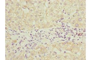 Immunohistochemistry of paraffin-embedded human liver cancer using ABIN7164691 at dilution of 1:100