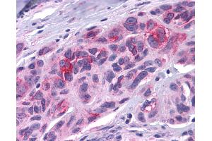 Anti-DUSP23 antibody IHC of human Skin, Melanoma. (DUSP23 抗体  (Internal Region))