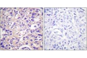 Immunohistochemistry analysis of paraffin-embedded human breast carcinoma, using TK (Phospho-Ser13) Antibody. (TK (AA 1-50), (pSer13) 抗体)
