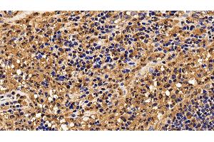 Immunohistochemistry (IHC) image for anti-Interleukin 13 Receptor, alpha 2 (IL13RA2) (AA 238-334) antibody (ABIN7437515)