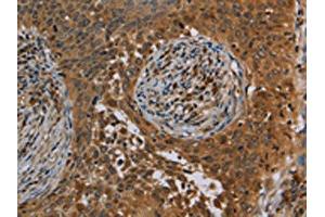 The image on the left is immunohistochemistry of paraffin-embedded Human cervical cancer tissue using ABIN7191746(OSM Antibody) at dilution 1/40, on the right is treated with synthetic peptide. (Oncostatin M 抗体)